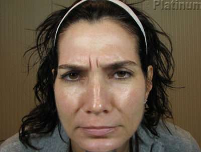 Botox