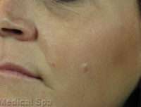 IPL / Photofacial