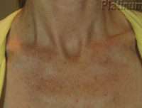 IPL / Photofacial