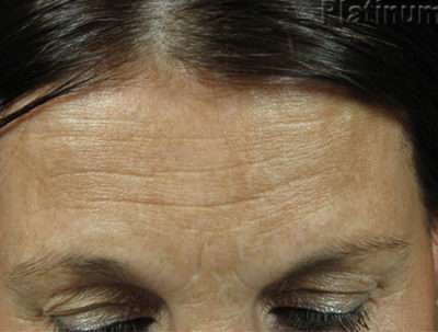 IPL / Photofacial