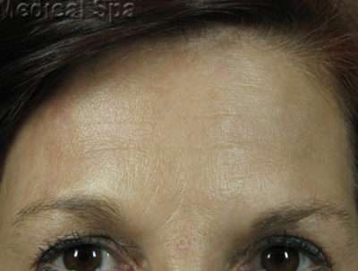 IPL / Photofacial