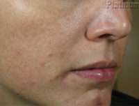 Dermal Fillers