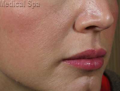 Dermal Fillers