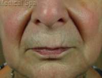 Dermal Fillers