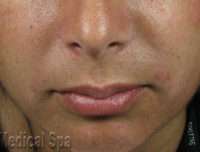 Dermal Fillers