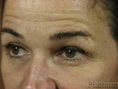 Laser Resurfacing