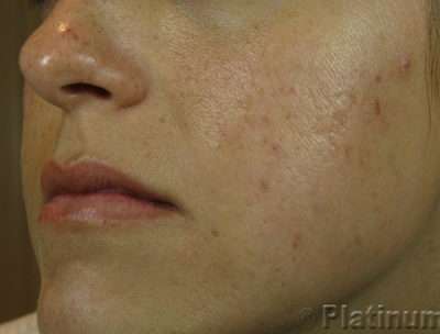 Laser Resurfacing