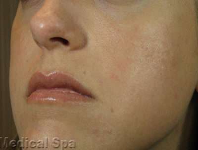 Laser Resurfacing