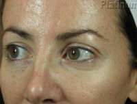 Laser Resurfacing