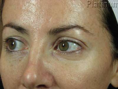 Laser Resurfacing