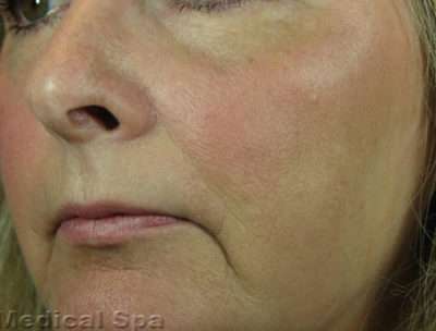 Laser Resurfacing