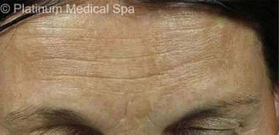 IPL / Photofacial