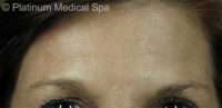 IPL / Photofacial