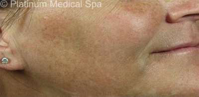 IPL / Photofacial