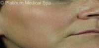 IPL / Photofacial