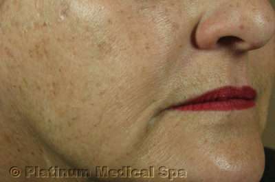 IPL / Photofacial