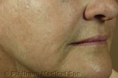 IPL / Photofacial