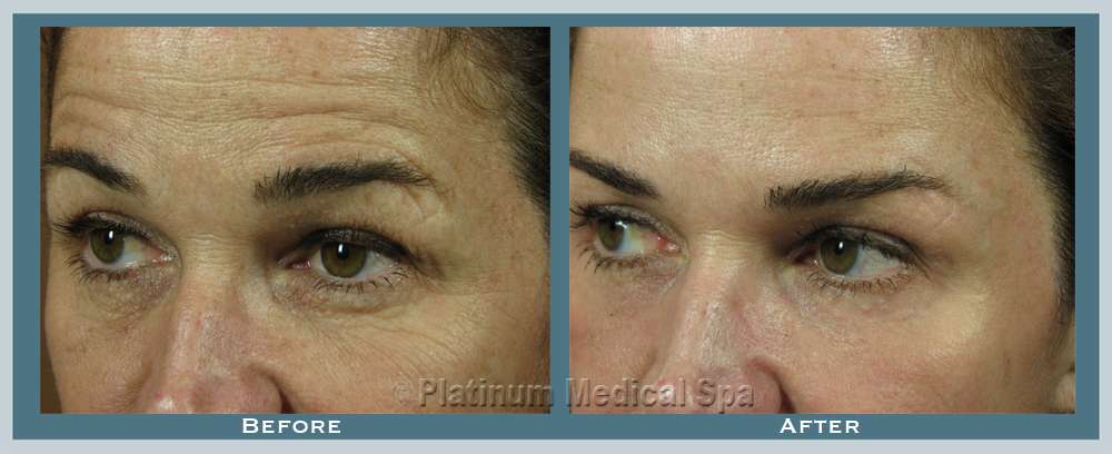 Orange County Laser Resurfacing 