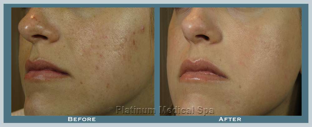 Orange County Laser Resurfacing 