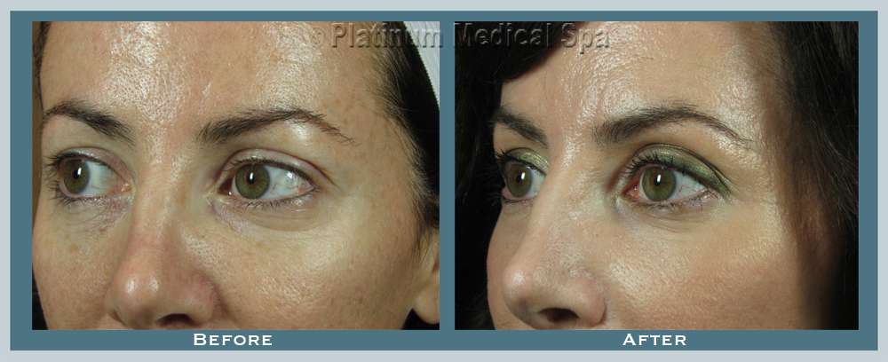 Orange County Laser Resurfacing 