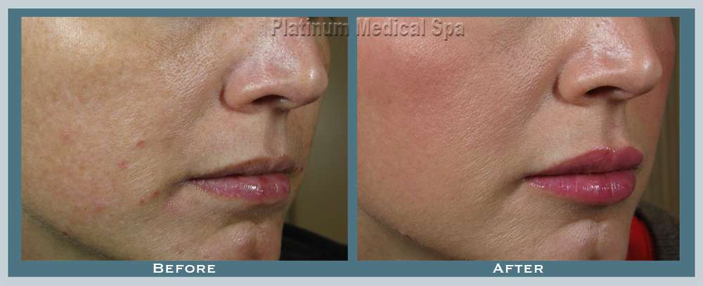 Juvederm Orange County