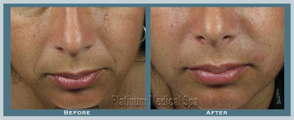 Orange County Juvederm 