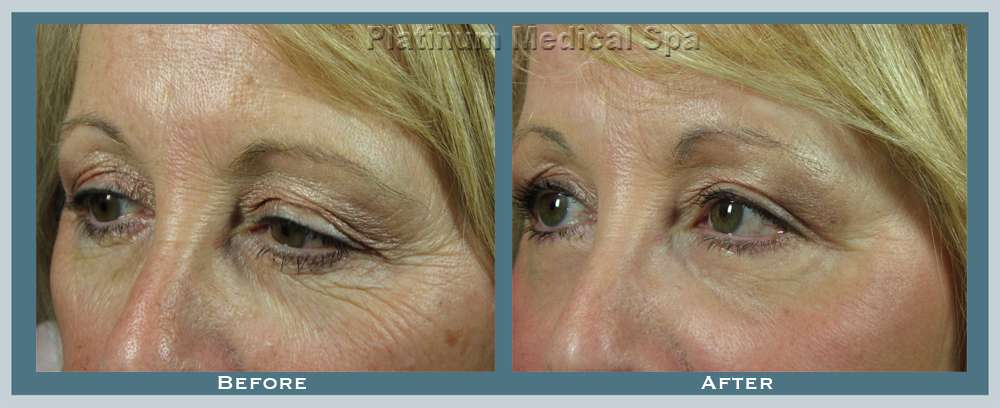 Laser Resurfacing Orange County