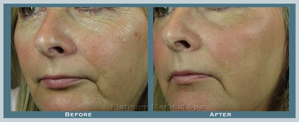 Fractional CO2 Laser Resurfacing Irvine & Orange County