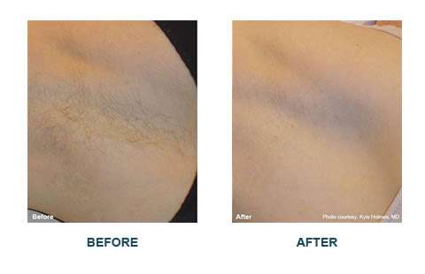 Laser Hair Removal Orange County