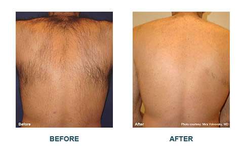 Laser Hair Removal Orange County