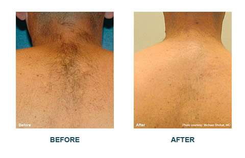 Laser Hair Removal Neck Orange County