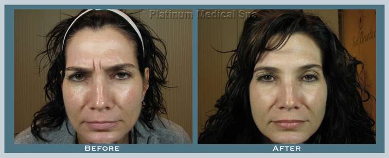 botox orange county