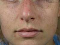 IPL / Photofacial