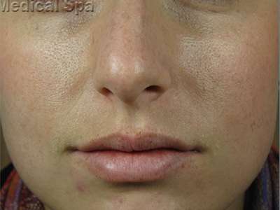 IPL / Photofacial