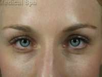 IPL / Photofacial