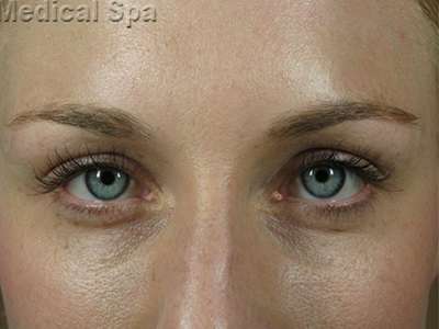 IPL / Photofacial