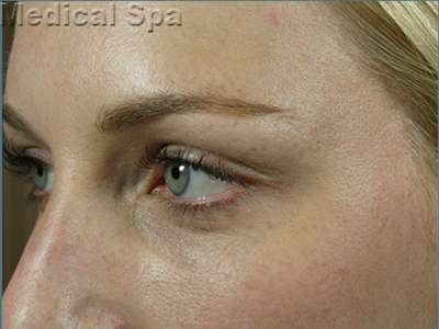 IPL / Photofacial