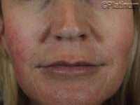 Dermal Fillers