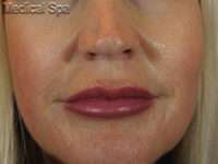 Dermal Fillers