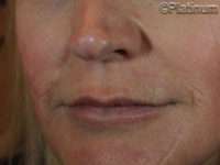 Dermal Fillers