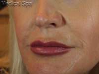 Dermal Fillers