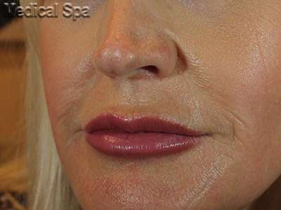 Dermal Fillers