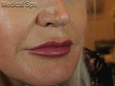 Dermal Fillers