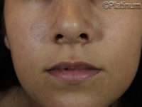 Dermal Fillers