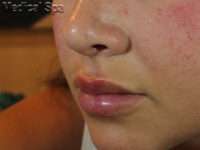 Dermal Fillers