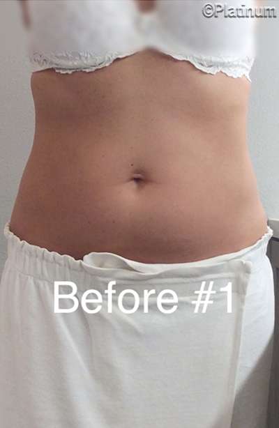 Fat Reduction