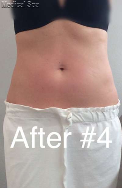 Fat Reduction