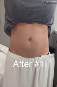 Fat Reduction