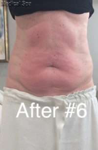 Fat Reduction