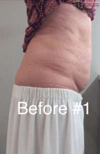 Fat Reduction